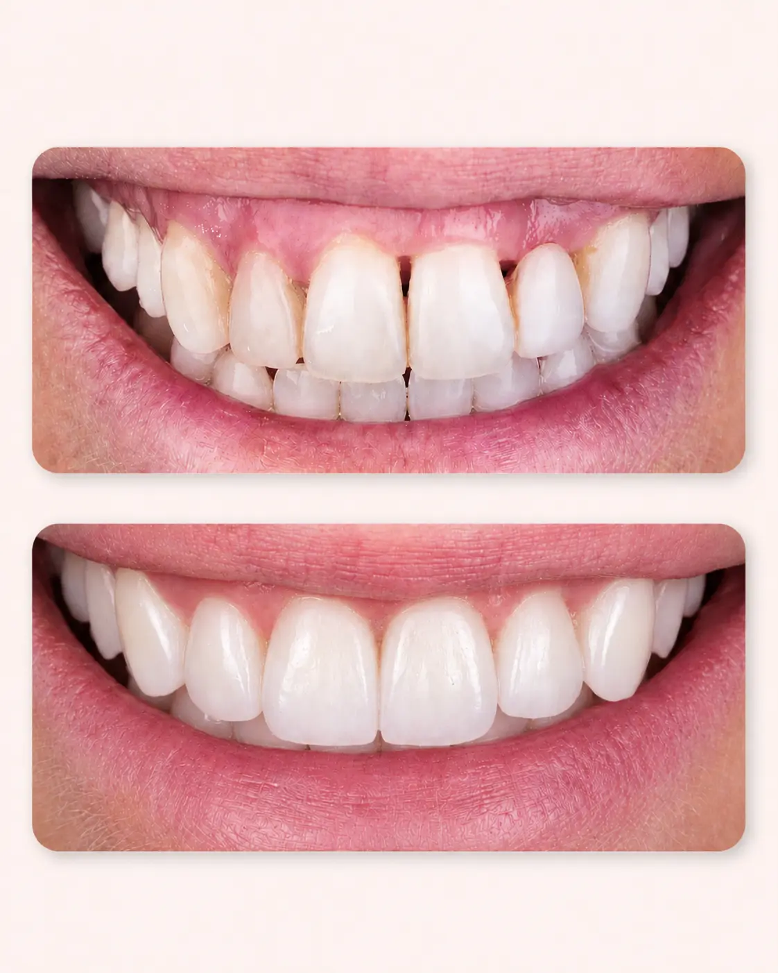 facettes dentaires - art du sourire `