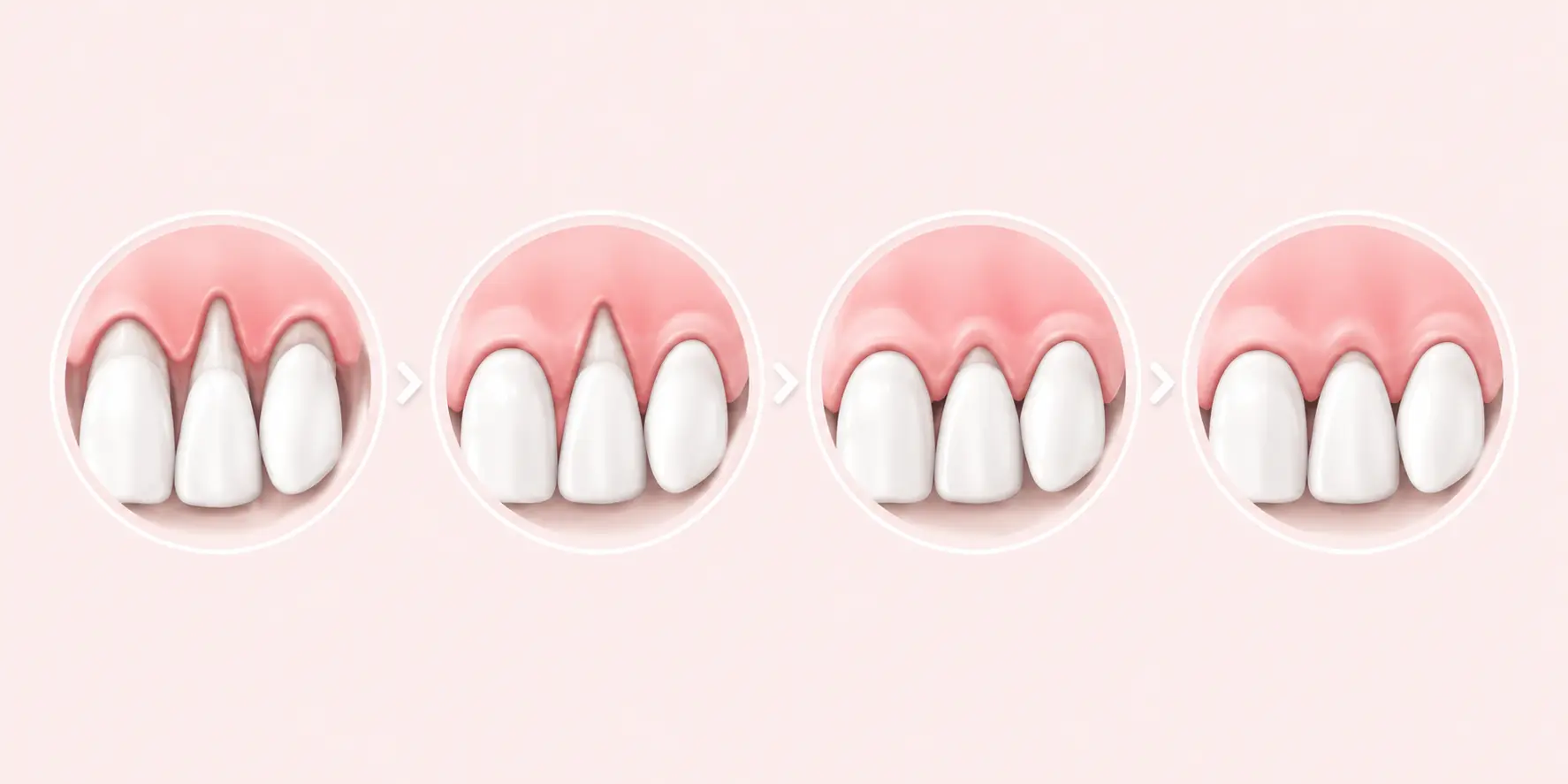 Greffe gingivale